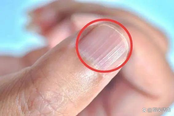 手指甲有竖纹是病吗?