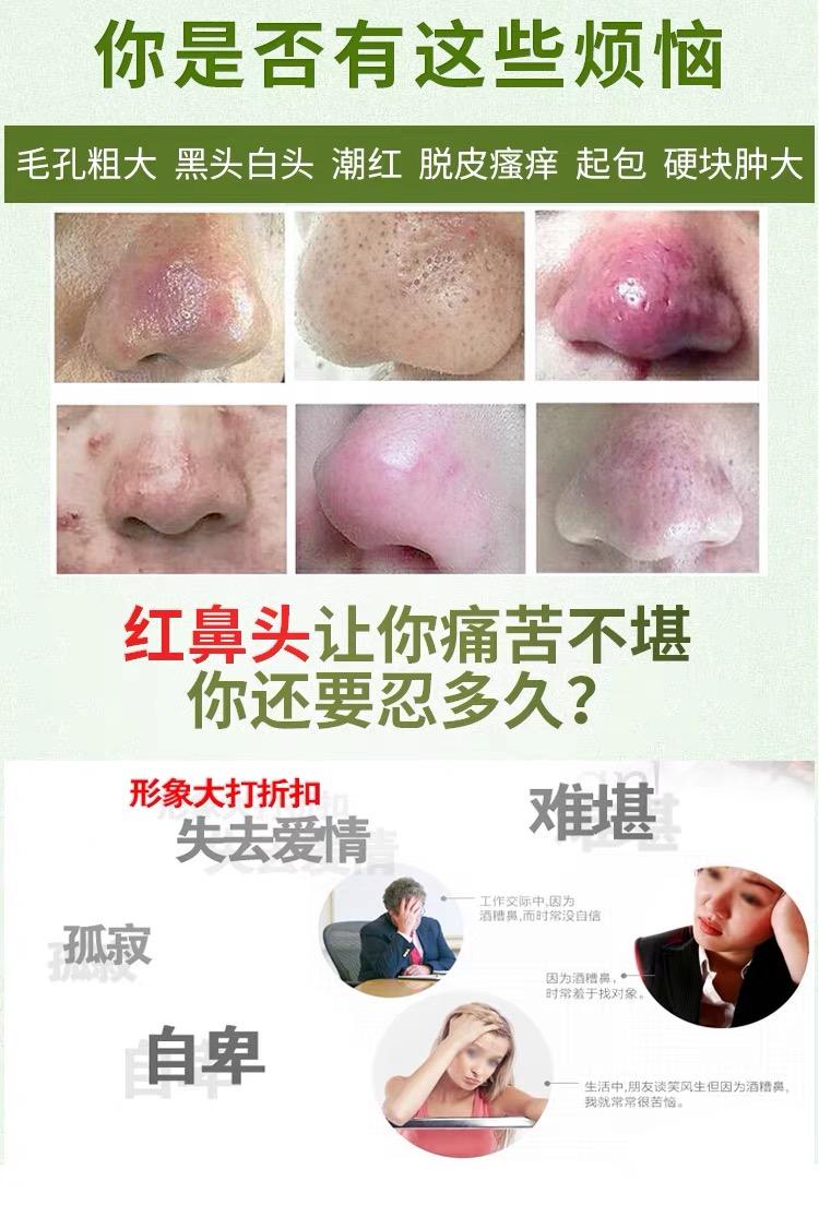 酒糟鼻的治疗方法