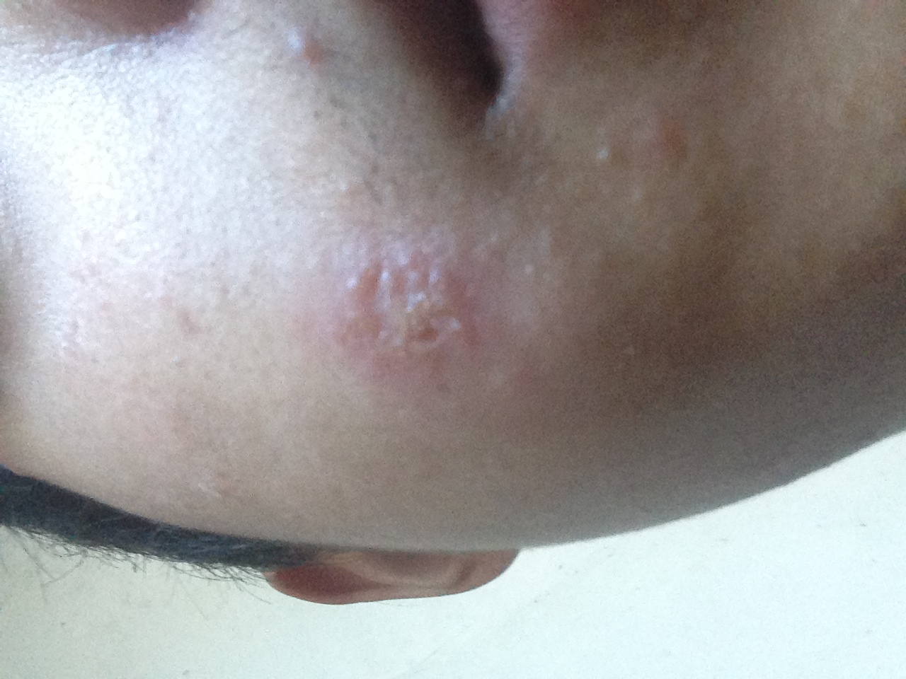 脸上起的凡一样的疙瘩,起了又落落了又起