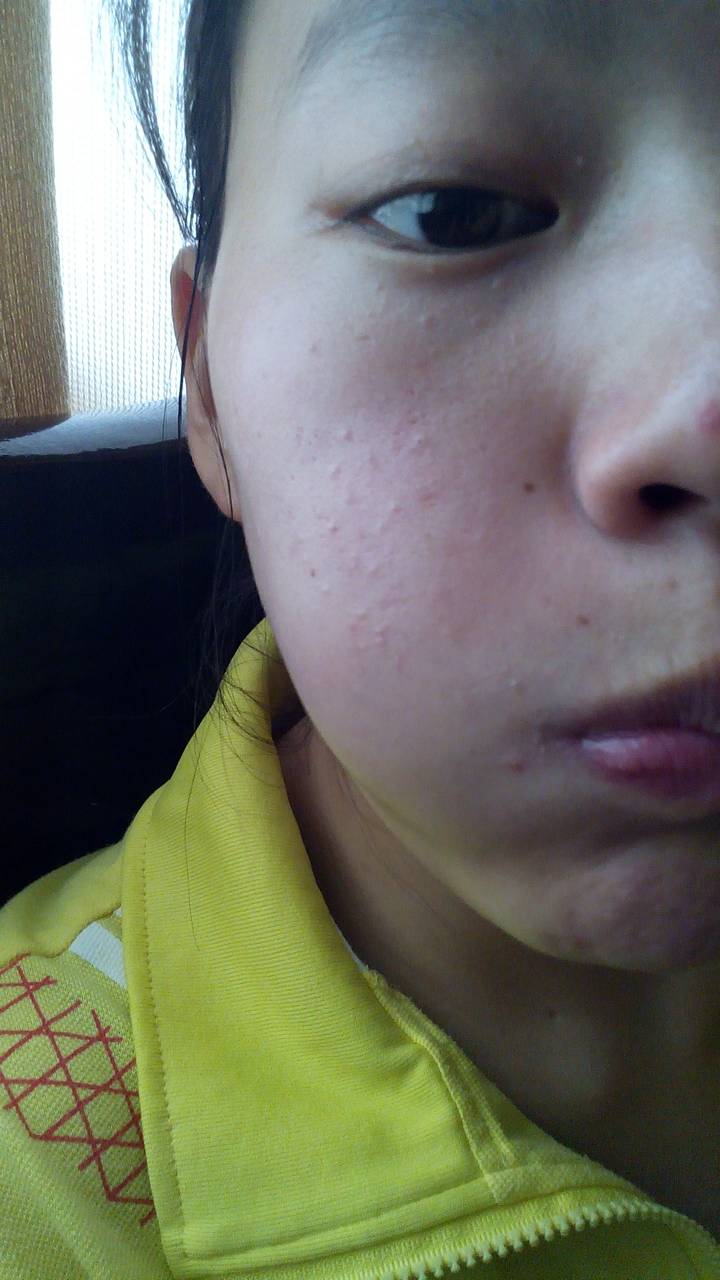 脸上起的凡一样的疙瘩,起了又落落了又起