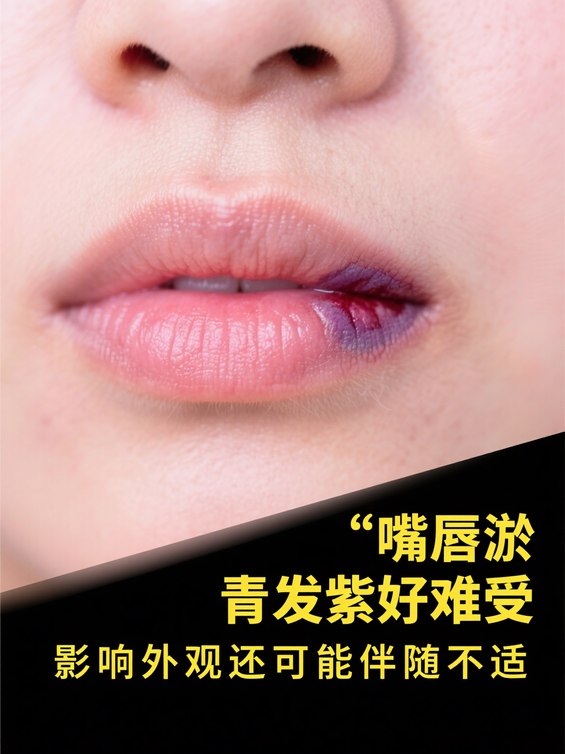 嘴唇发紫是怎么回事