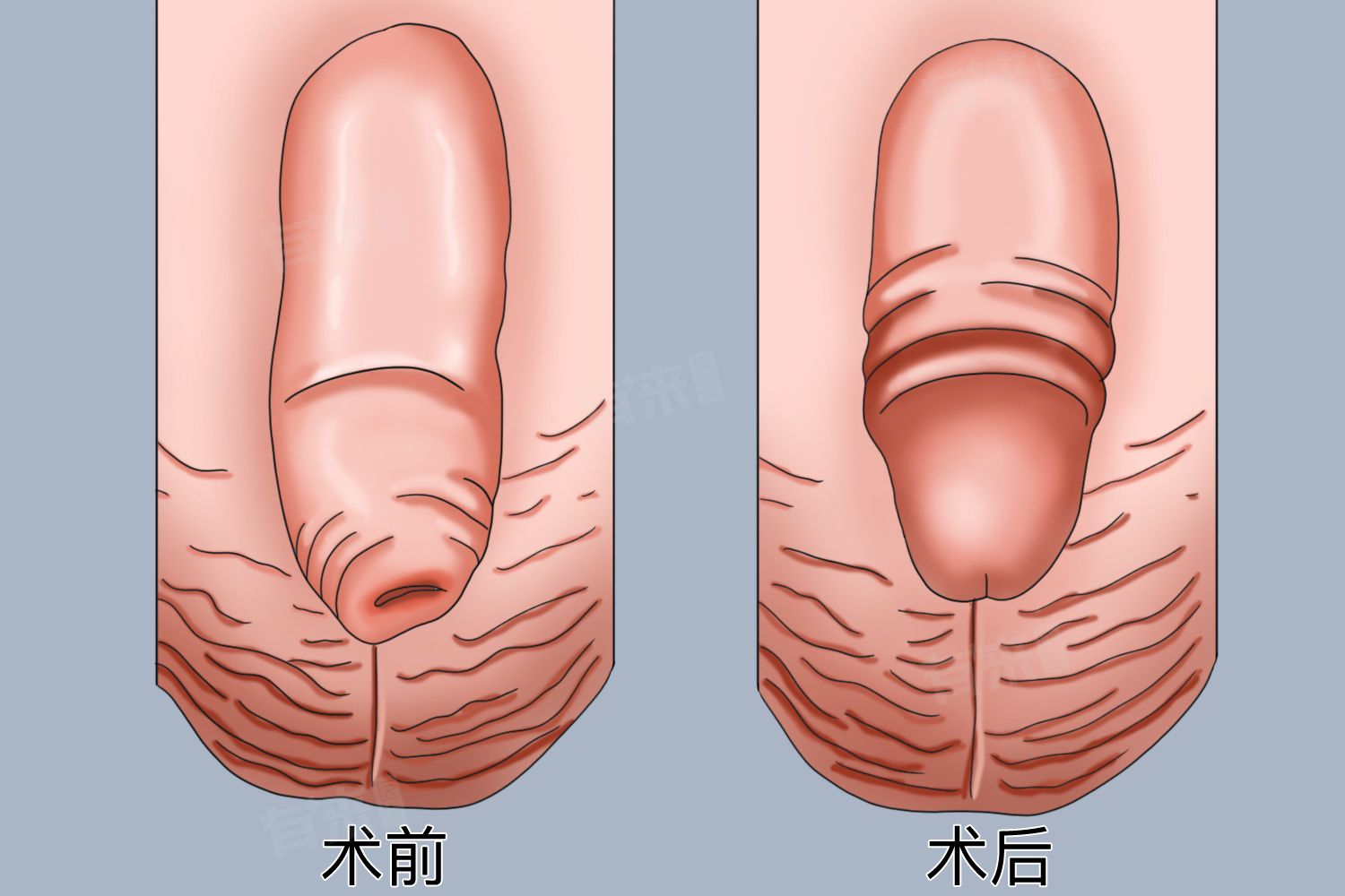 包皮手术的最佳年龄