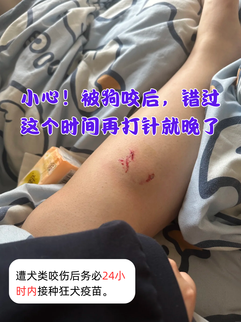 被狗咬了,狗十天内死了