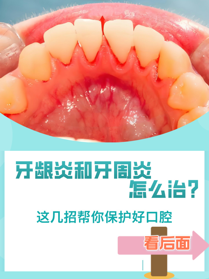 治疗牙周炎要花多少钱