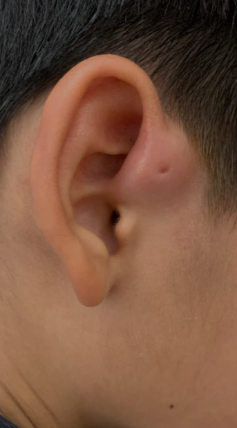 耳前瘘管有什么危害