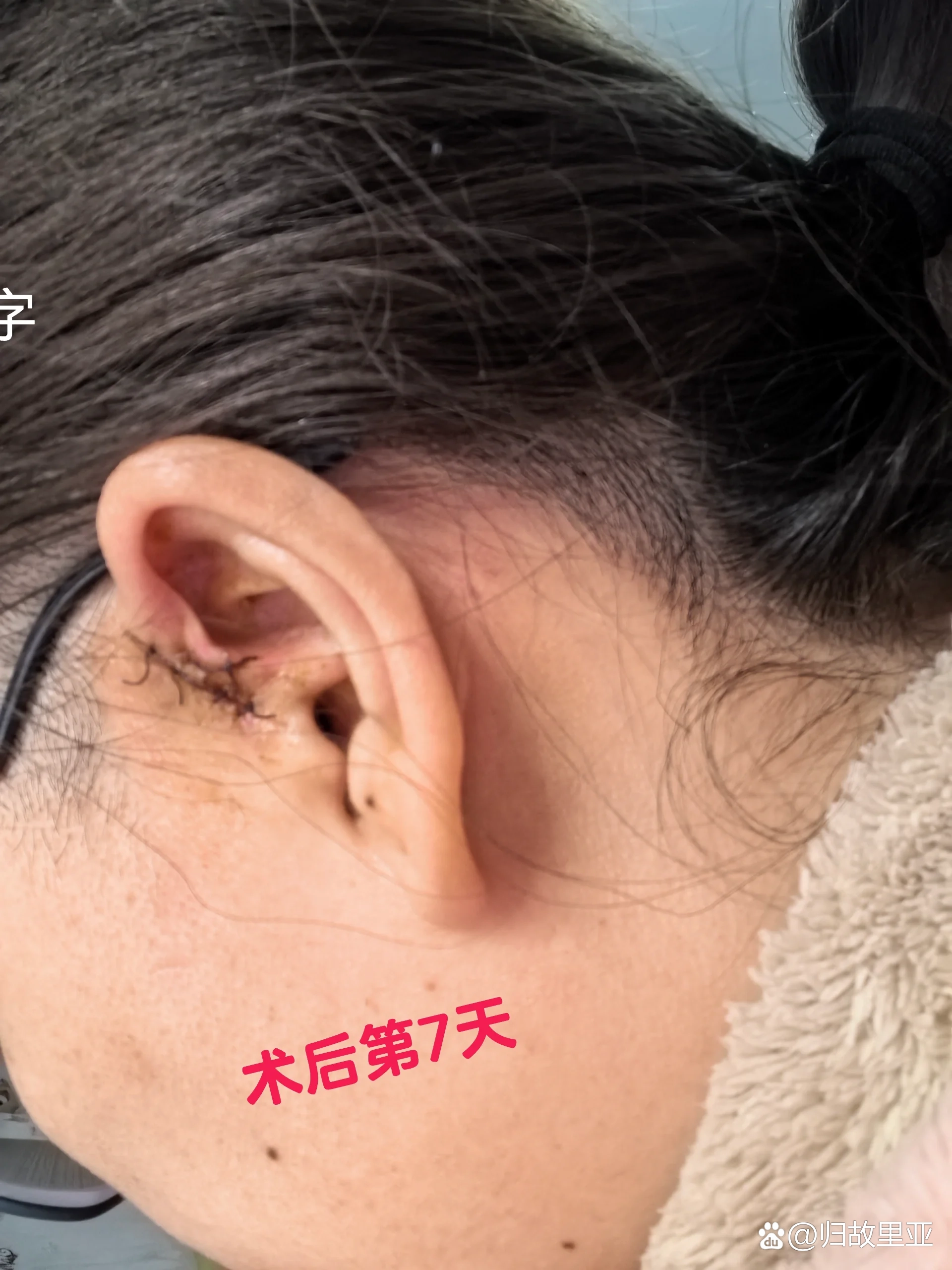 耳前瘘管有什么危害