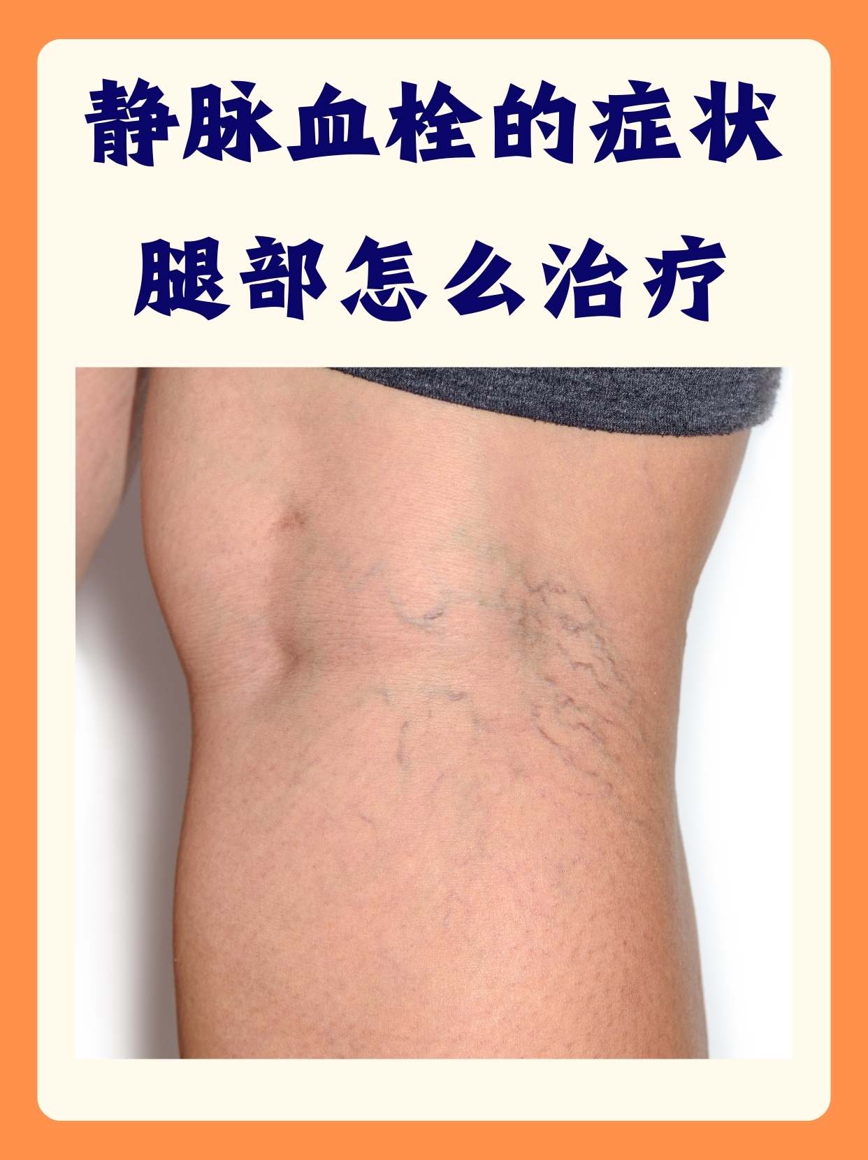 腿部血栓能治好吗