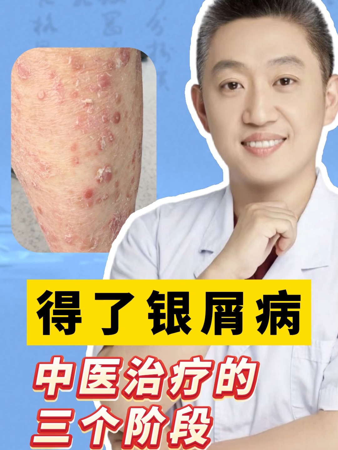 牛皮癣如何才能够根治