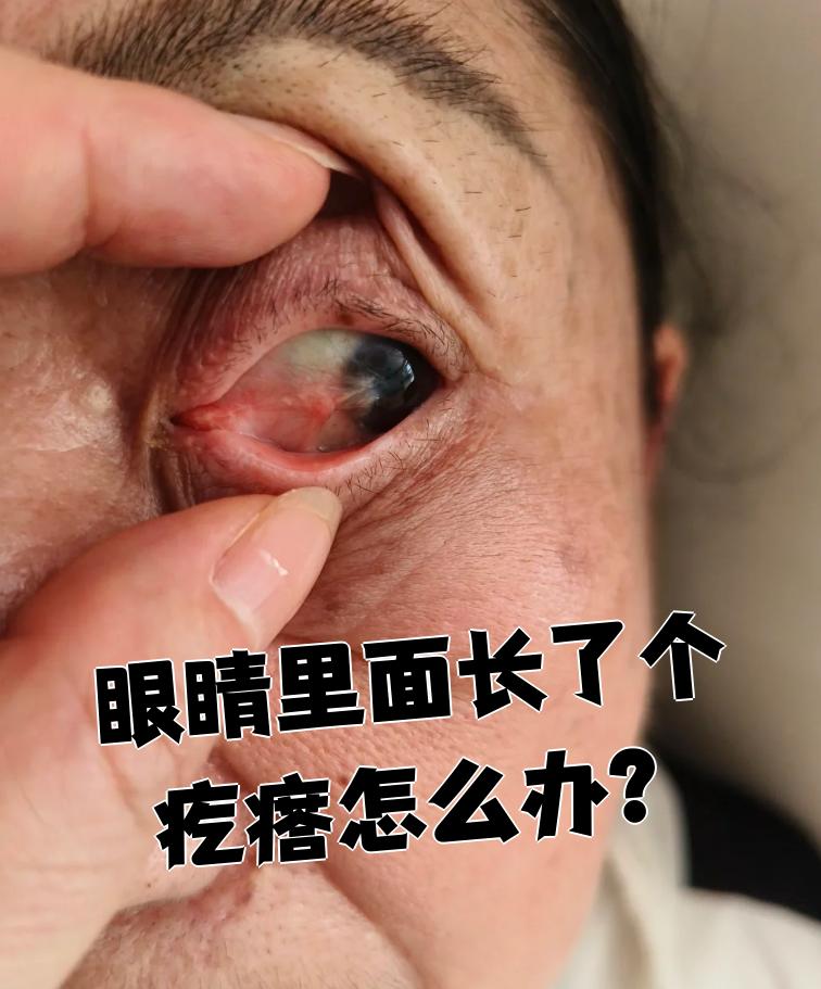眼皮里长了个疙瘩摸起来硬硬的