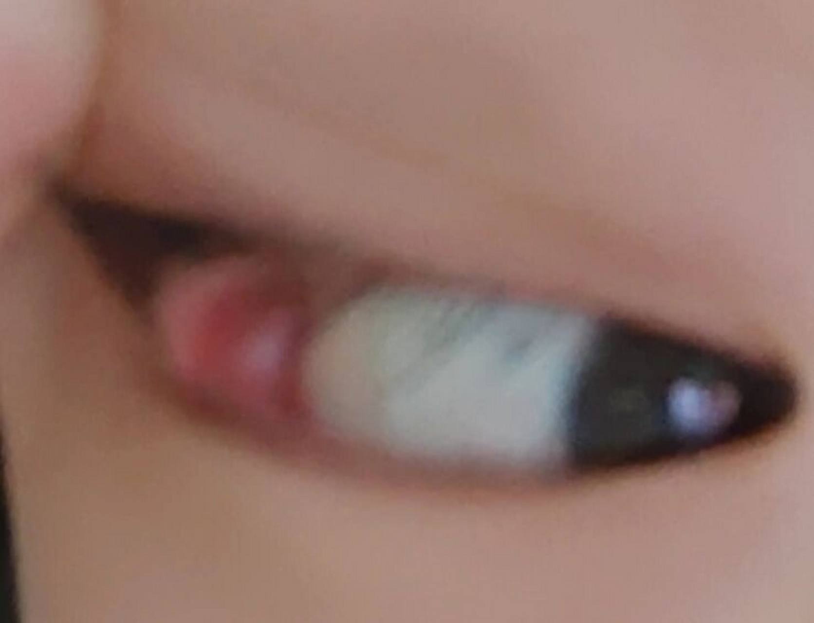 眼皮里长了个疙瘩摸起来硬硬的