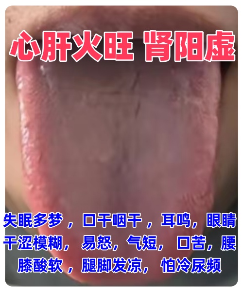 心火旺的症状