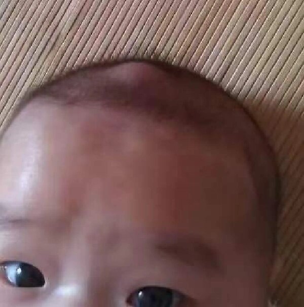 宝宝囟门凹陷怎么回事