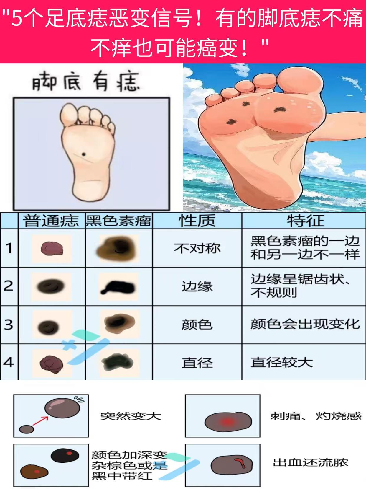 脚底突然长了一颗黑痣怎么办