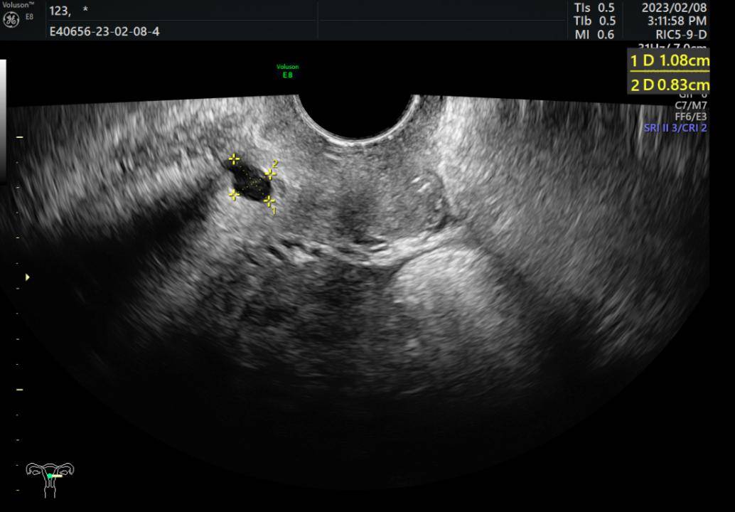 子宫囊肿严重吗