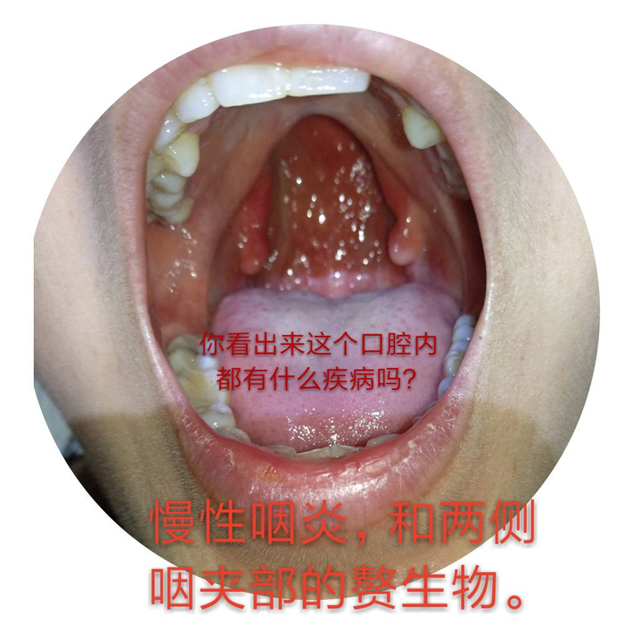 咽炎和咽喉炎的区别是什么?