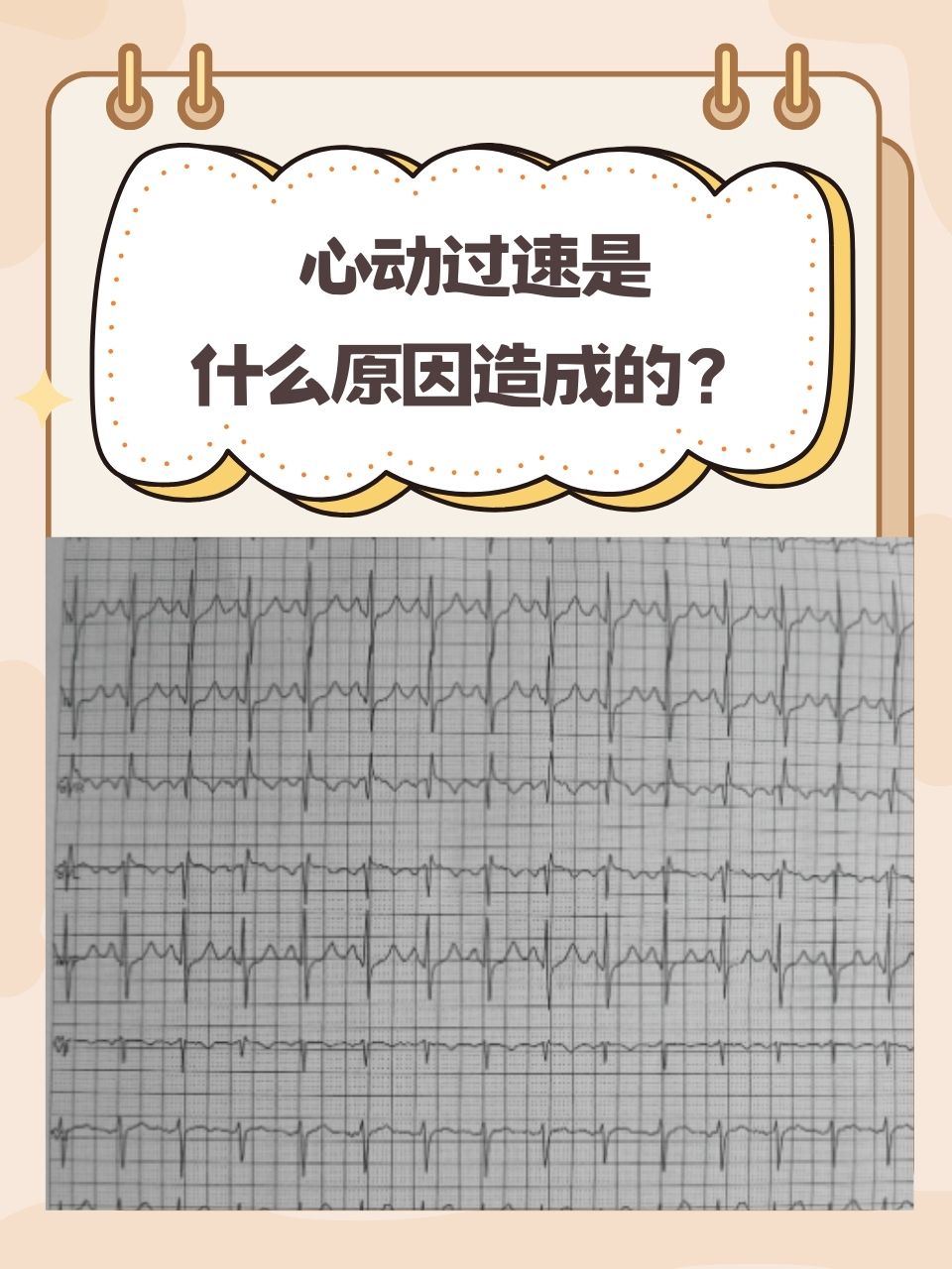 窦性心律过速怎么治