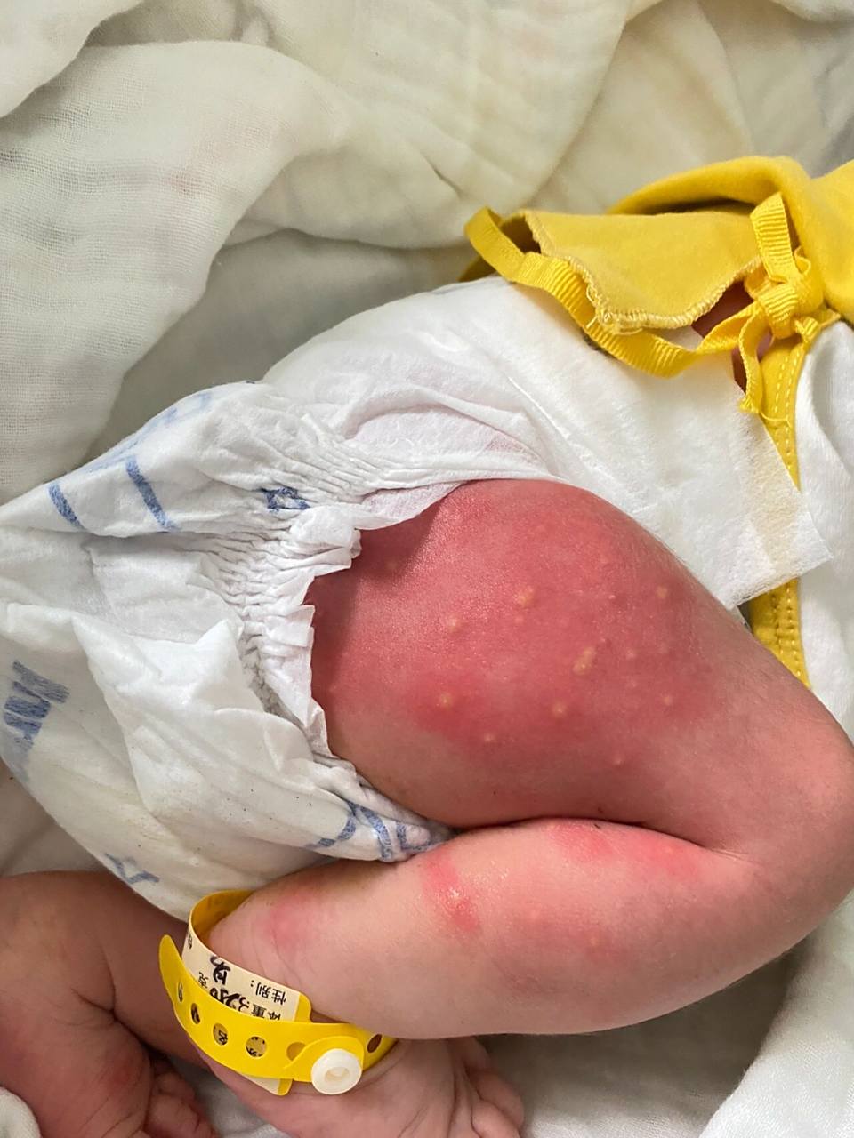 宝宝身上起的红疙瘩是什么?