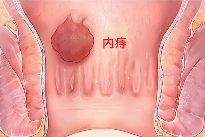 女性痔疮的症状图片