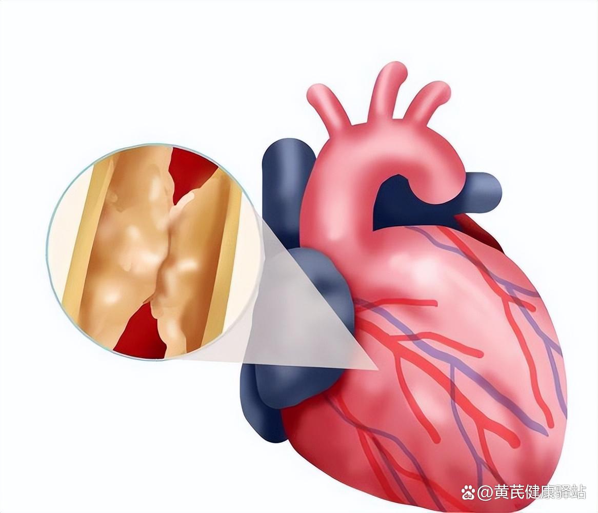 什么是急性冠脉综合征?