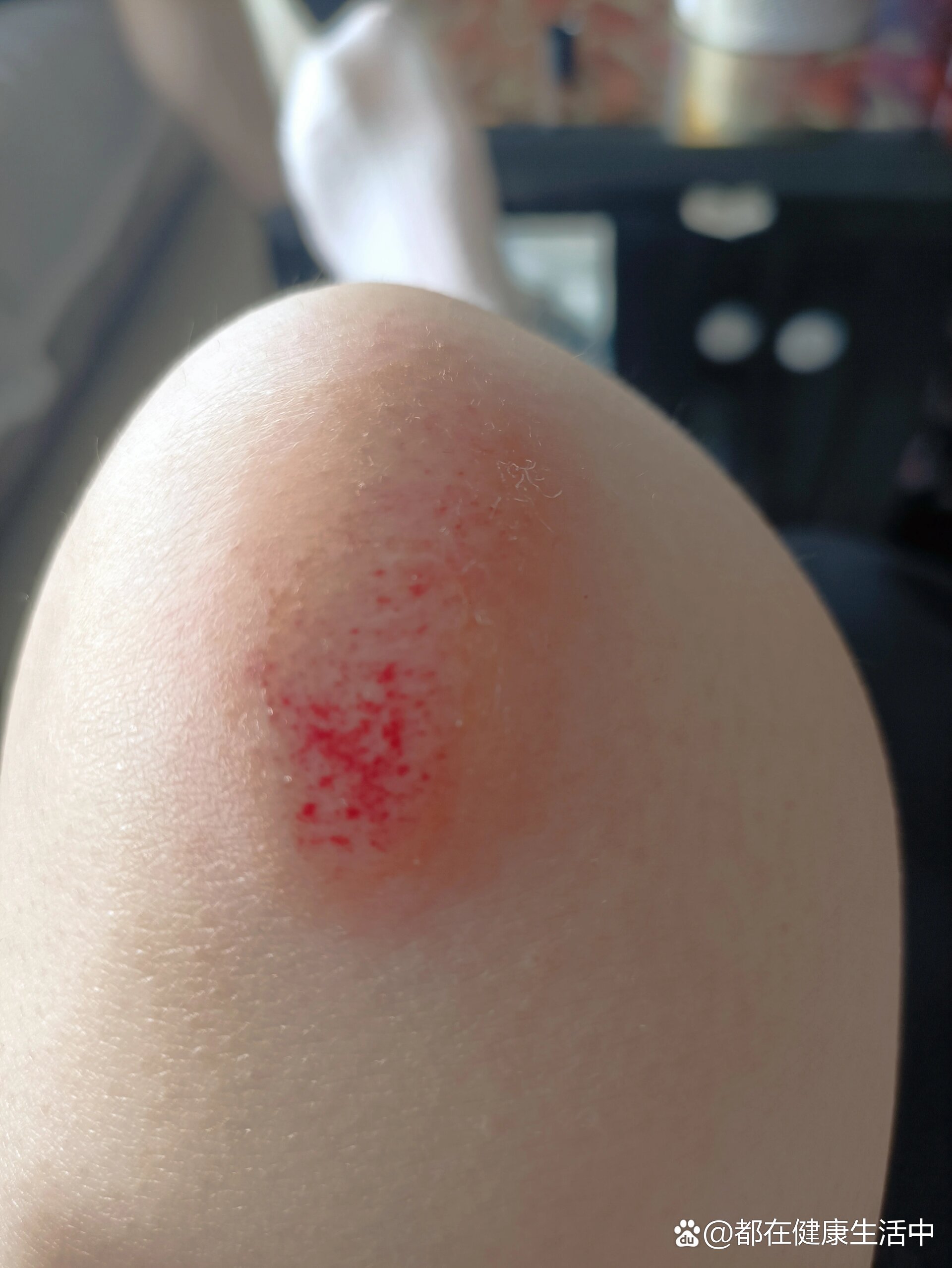 皮肤擦伤怎么好得快