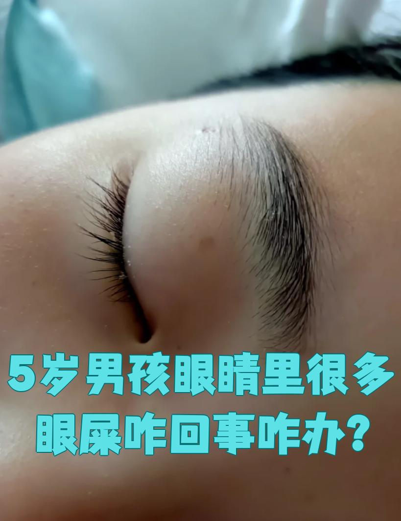 眼睛老是有眼屎怎么办