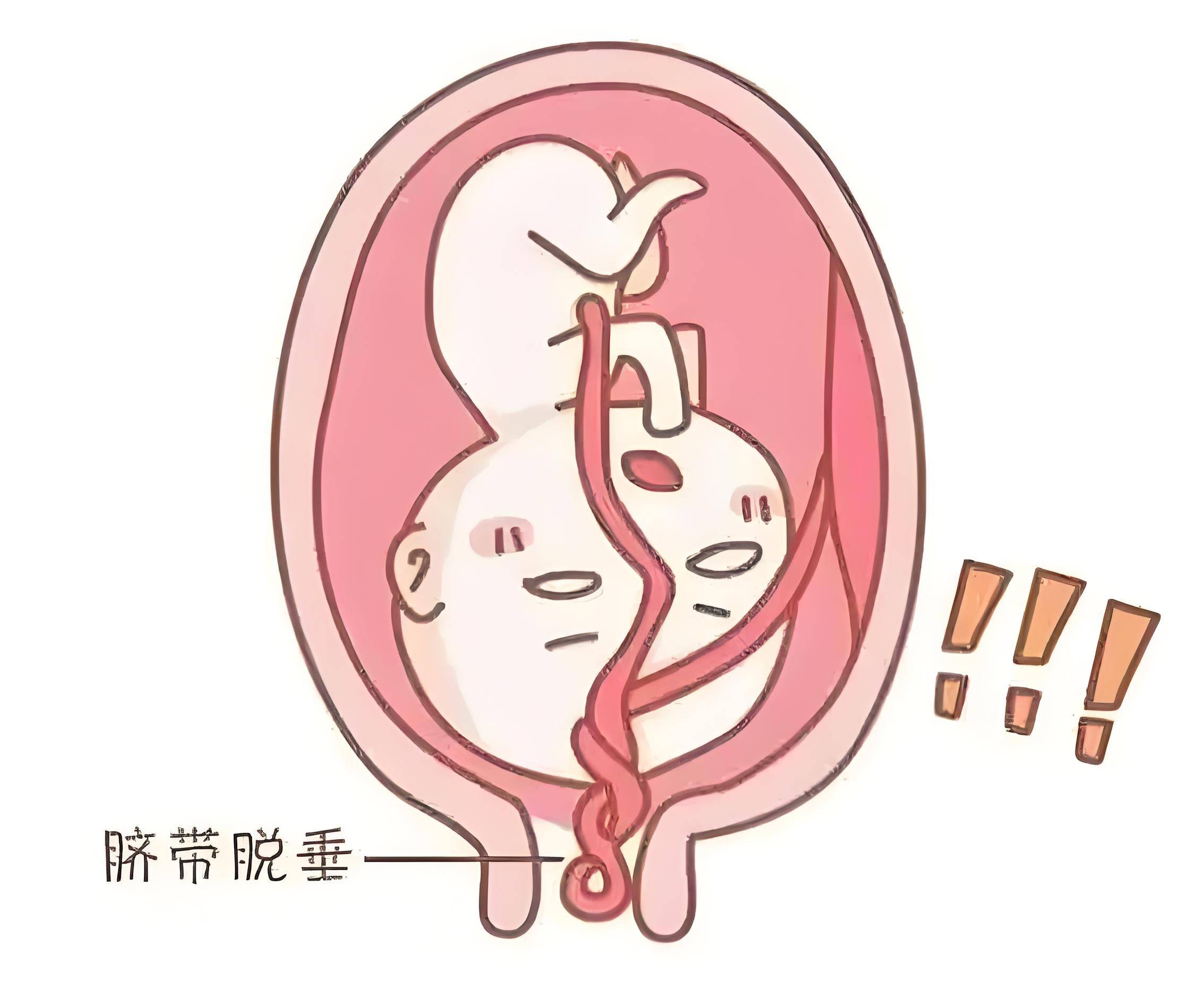 如果羊水破了胎儿还会动吗