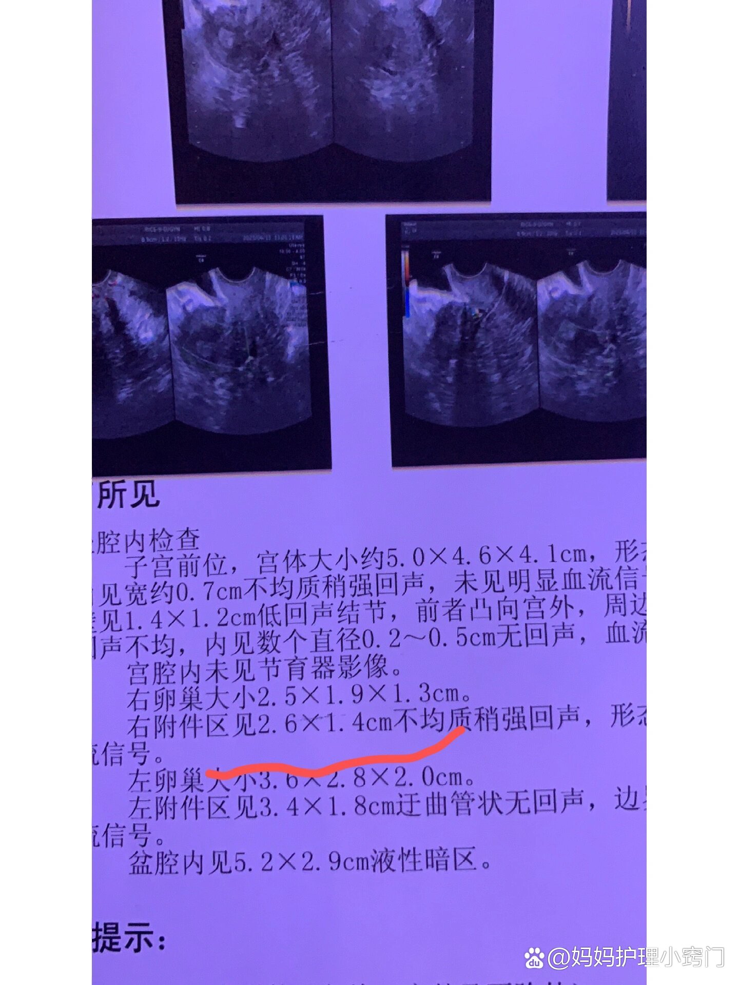 宫外孕保守治疗的利弊有哪些