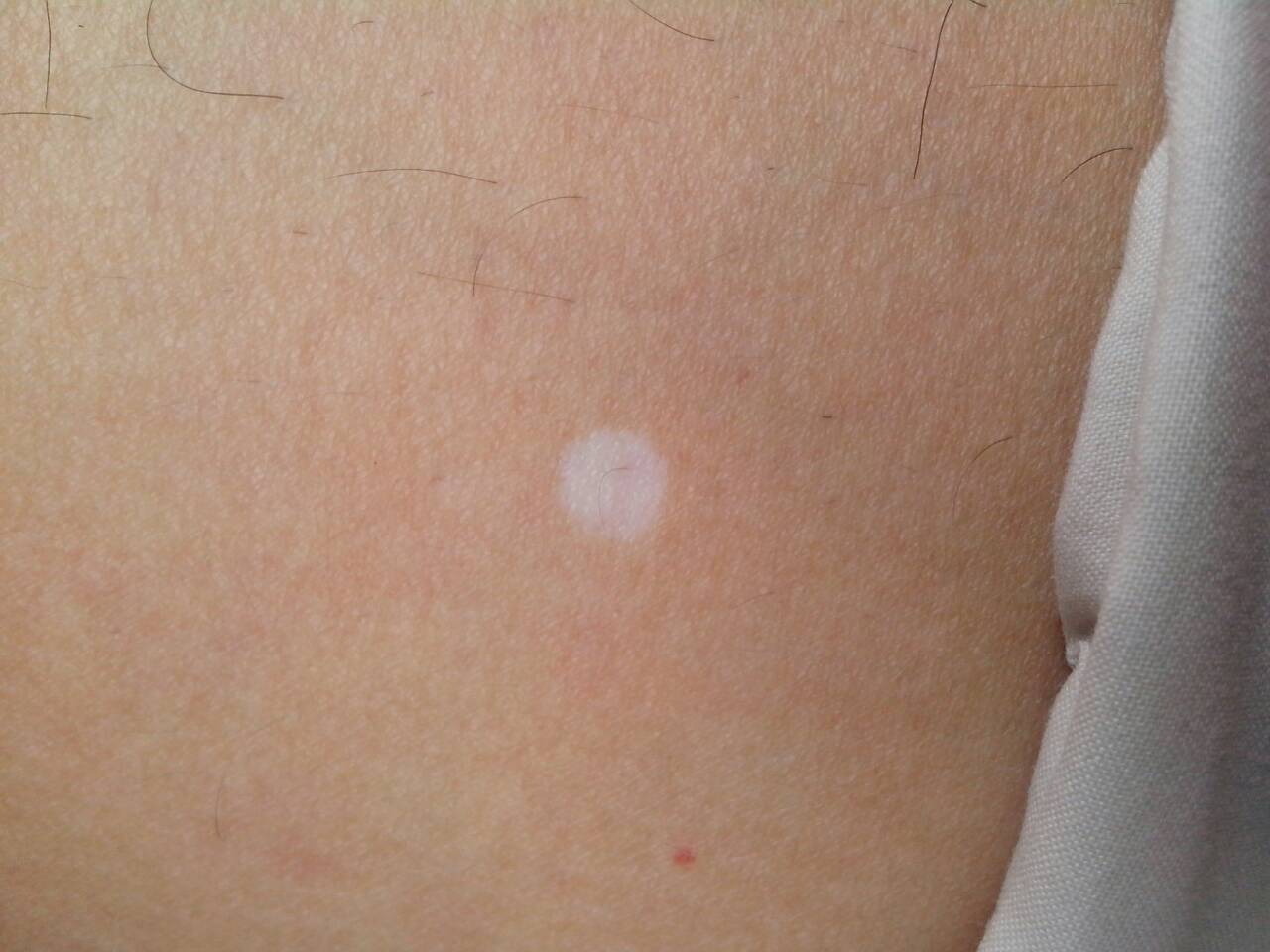 大腿都是这种小白点,身体有的也有