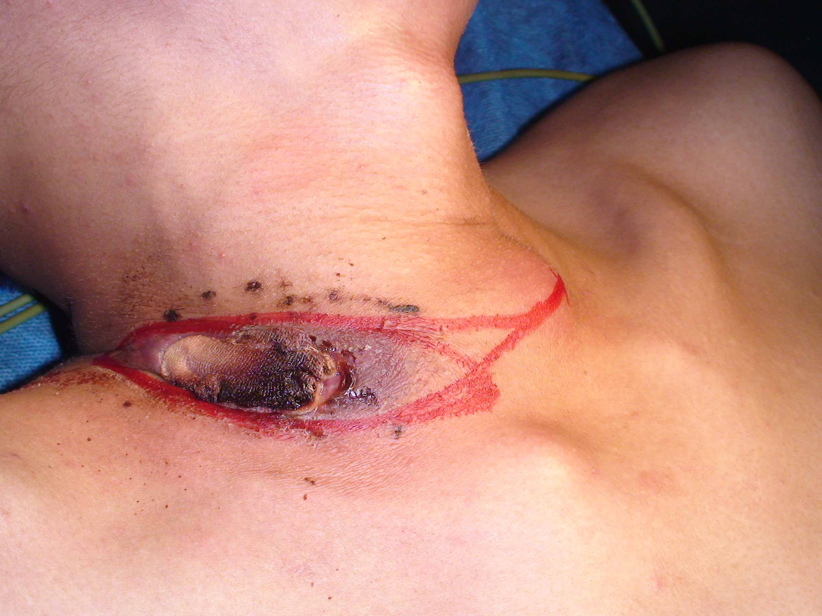 淋巴结核是怎么造成的