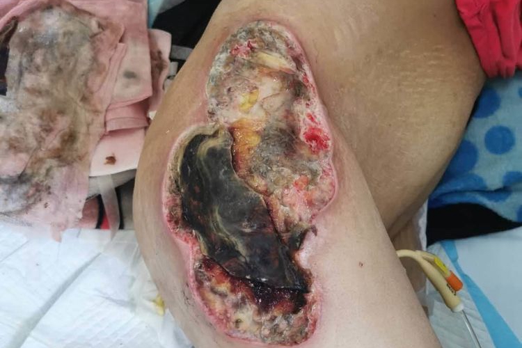 坏死性筋膜炎的症状