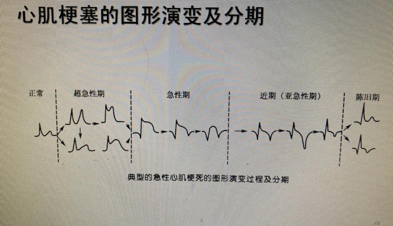 心肌梗死的前兆是什么