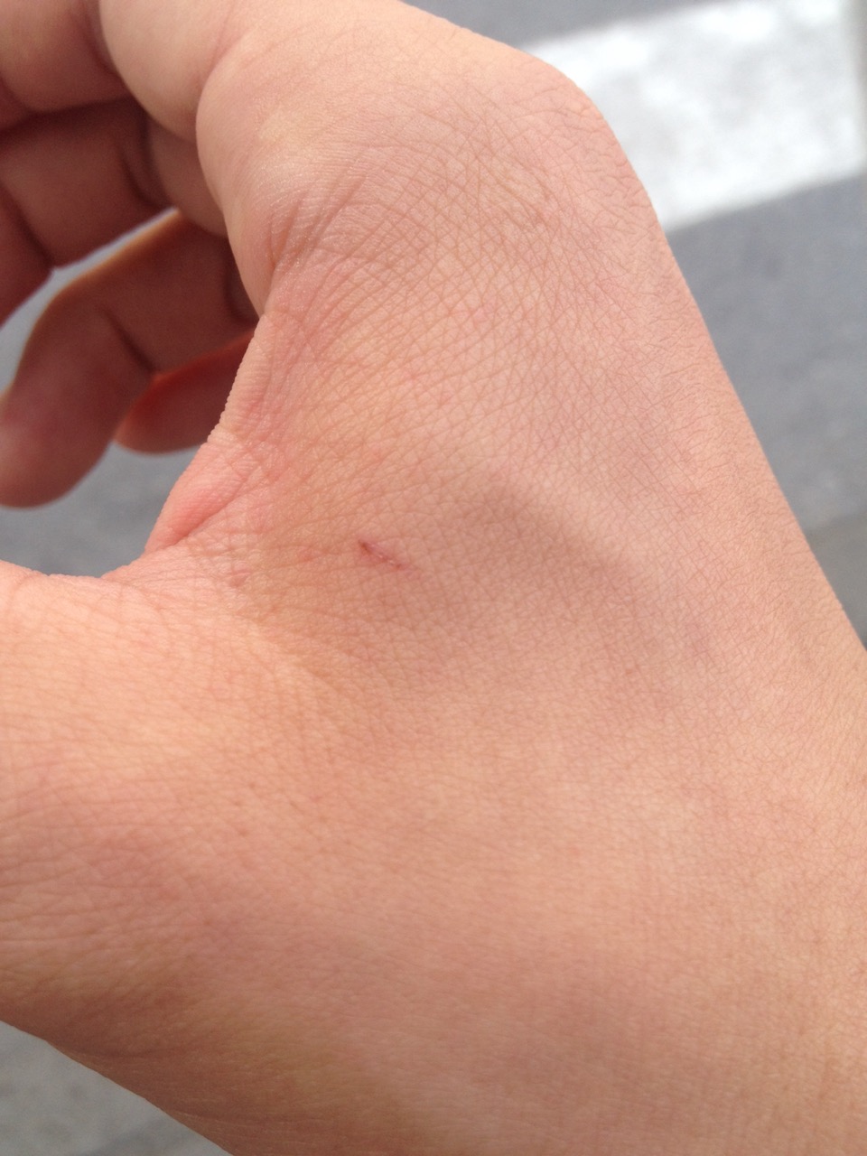 被小猫咬了一个小眼儿