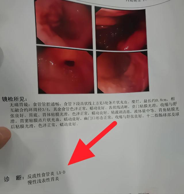 反流性食管炎症状有哪些?