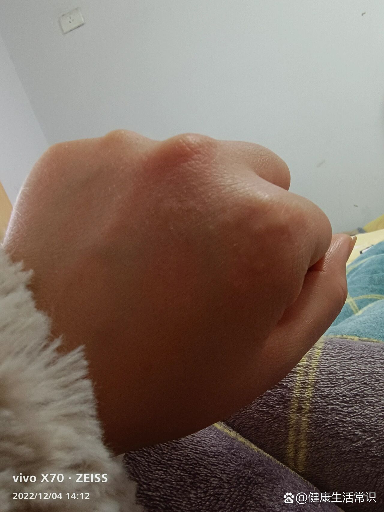 冬天手上起小疙瘩非常痒