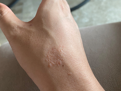 冬天手上起小疙瘩非常痒