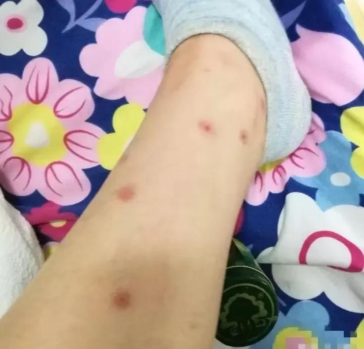 被跳蚤咬后怎么办?