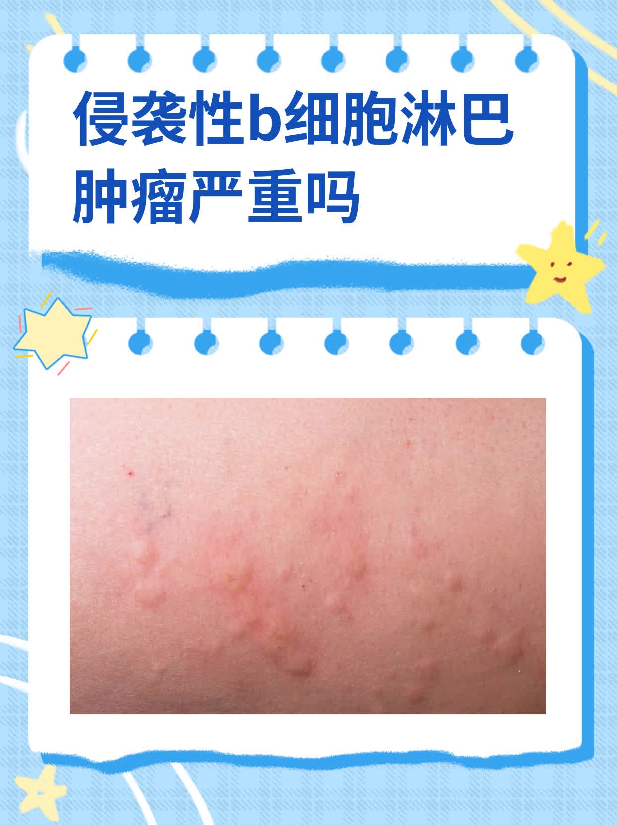 淋巴瘤和淋巴癌有区别吗?