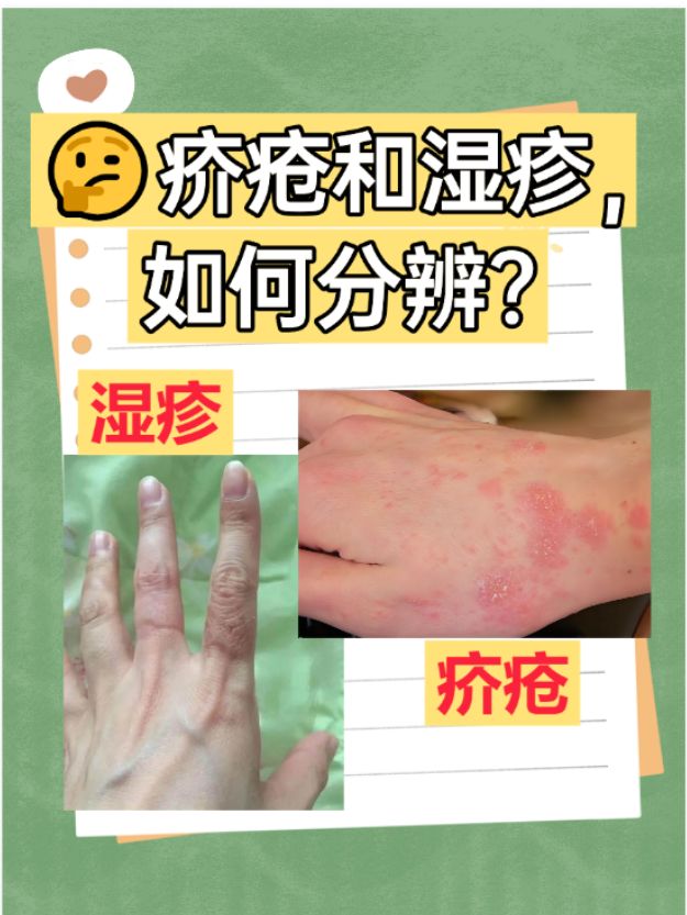 皮炎和湿疹传染吗