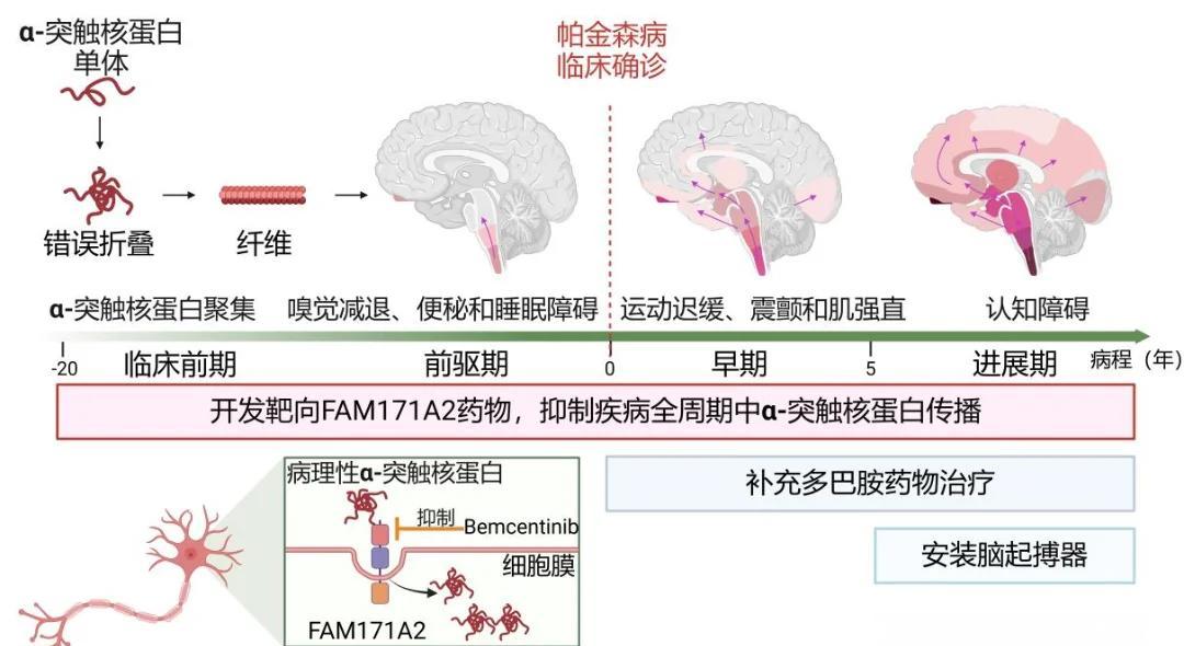 帕金森综合症能治好吗