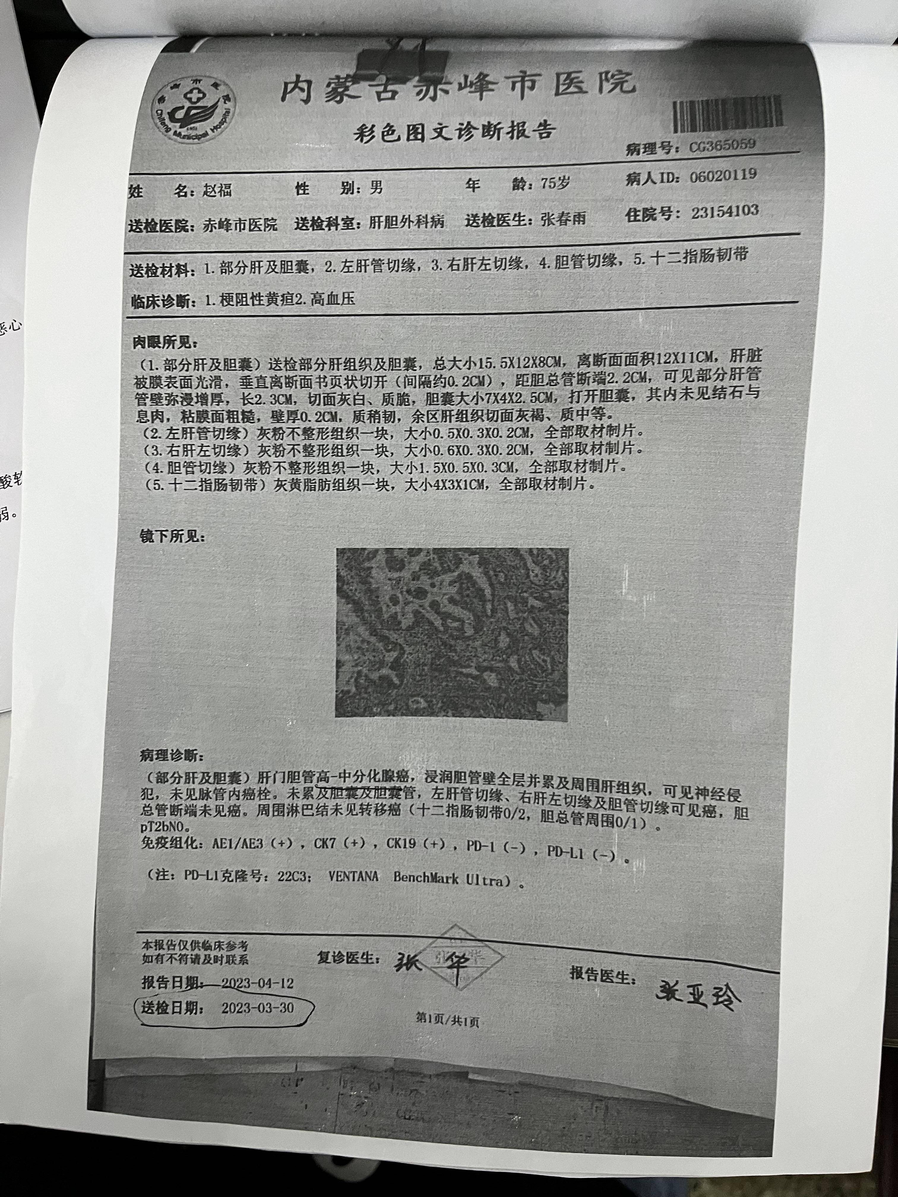 肝门部胆管癌能活多久