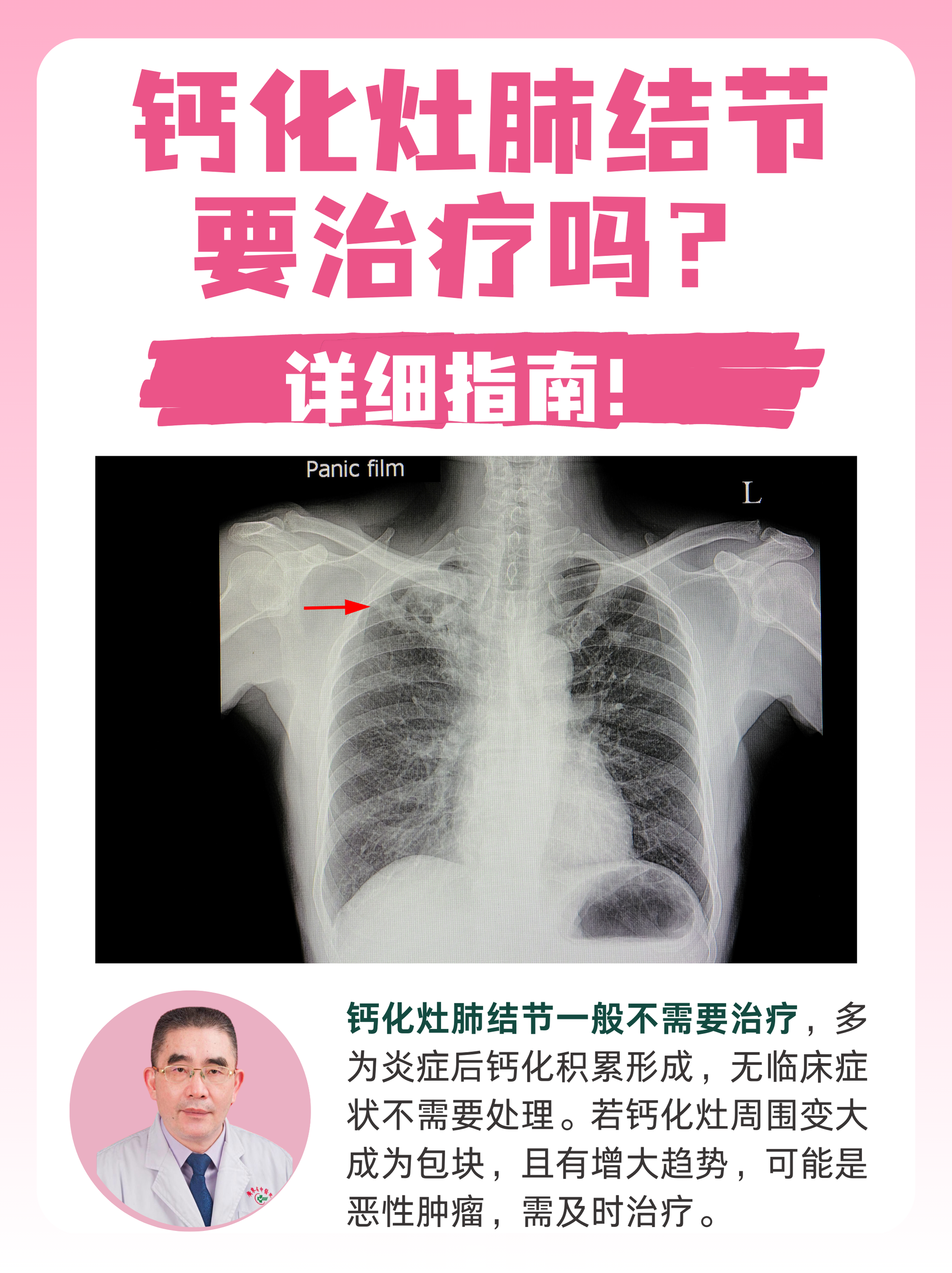 肝脏钙化灶需要治疗吗