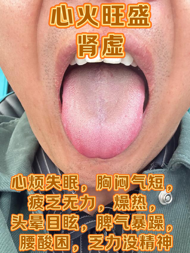 肾虚肝火旺的症状