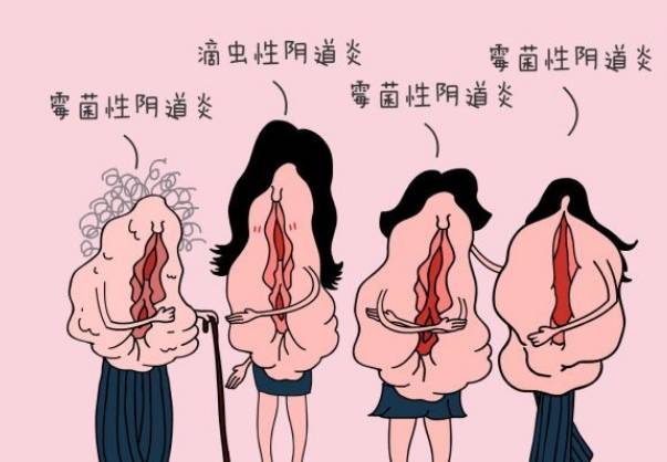 念珠菌阴道炎是怎么回事