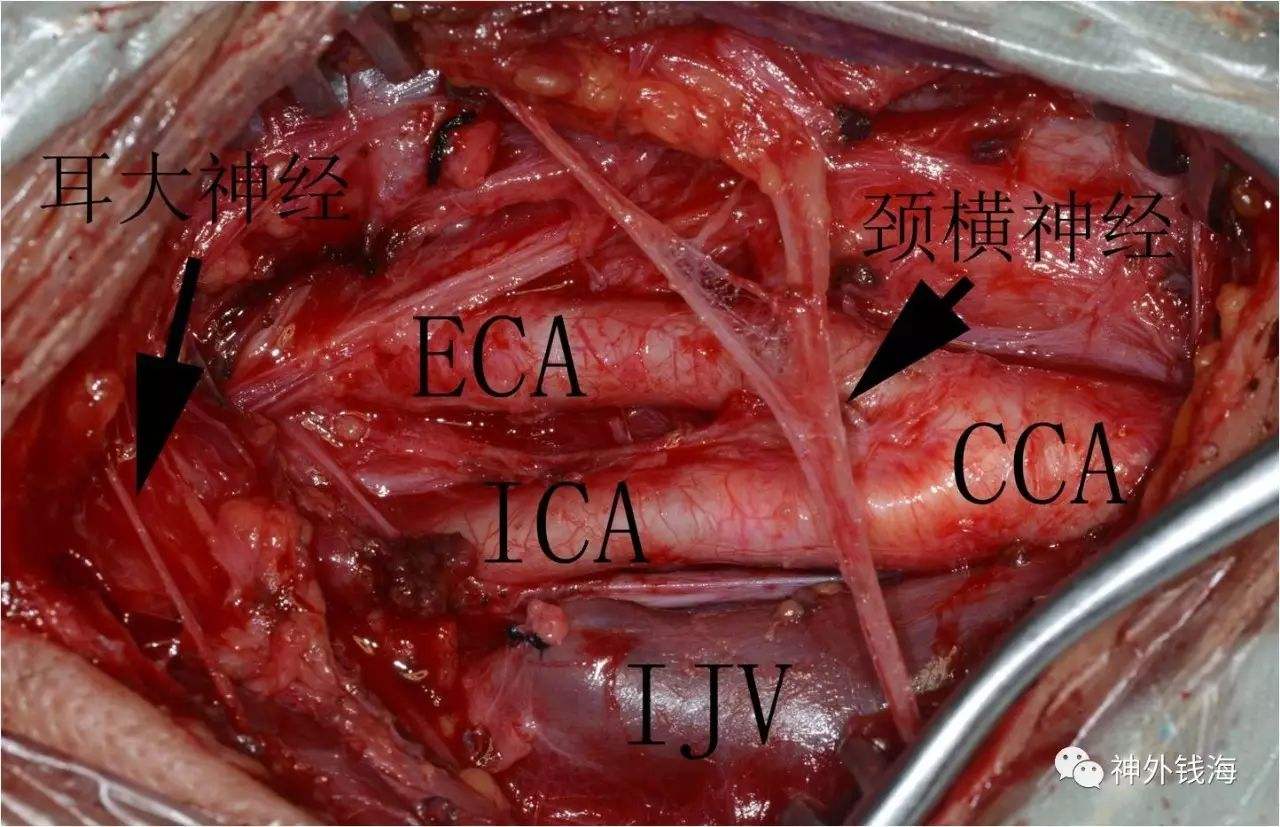 我想问下,割颈动脉要割多深就挂了