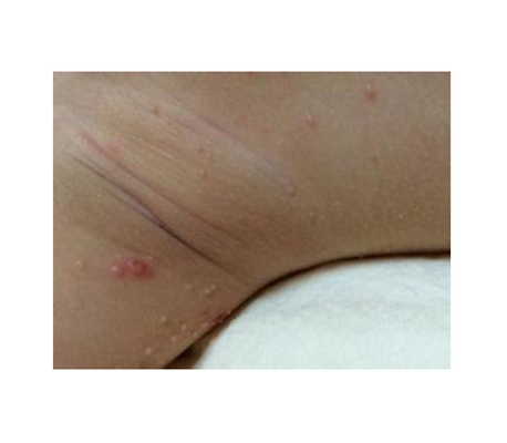 腋窝长了一个小肉疙瘩