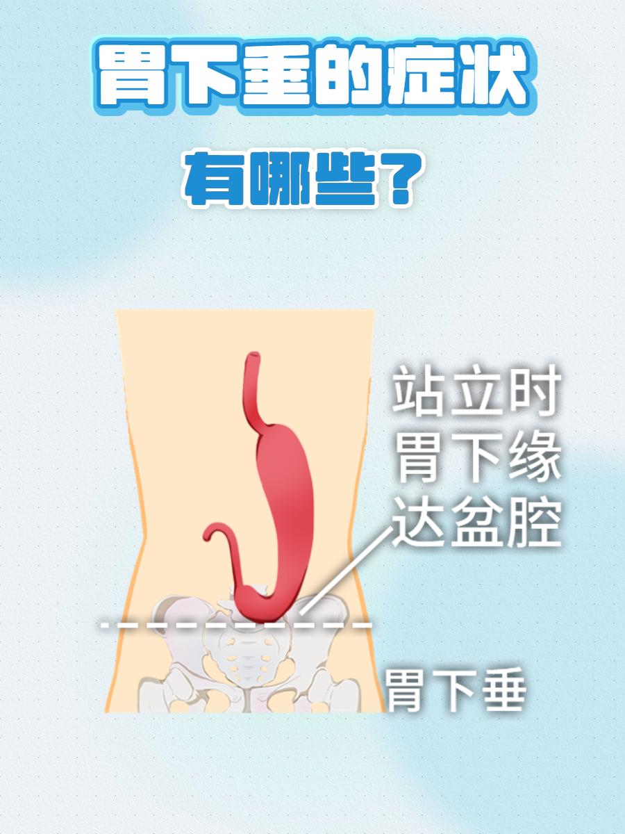 胃下垂是什么引起的