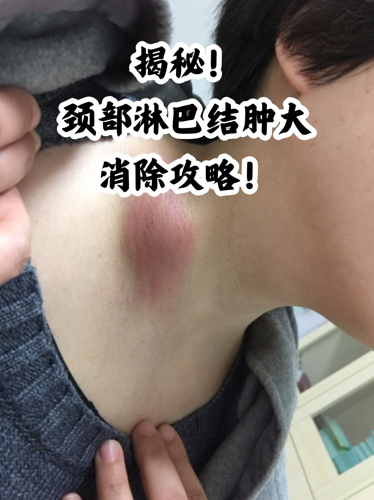 双侧颈部多发小淋巴结