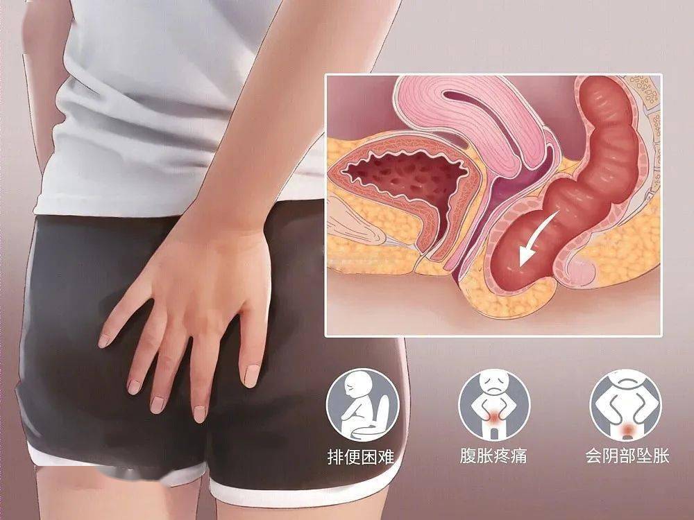 阴道松弛有哪些症状?