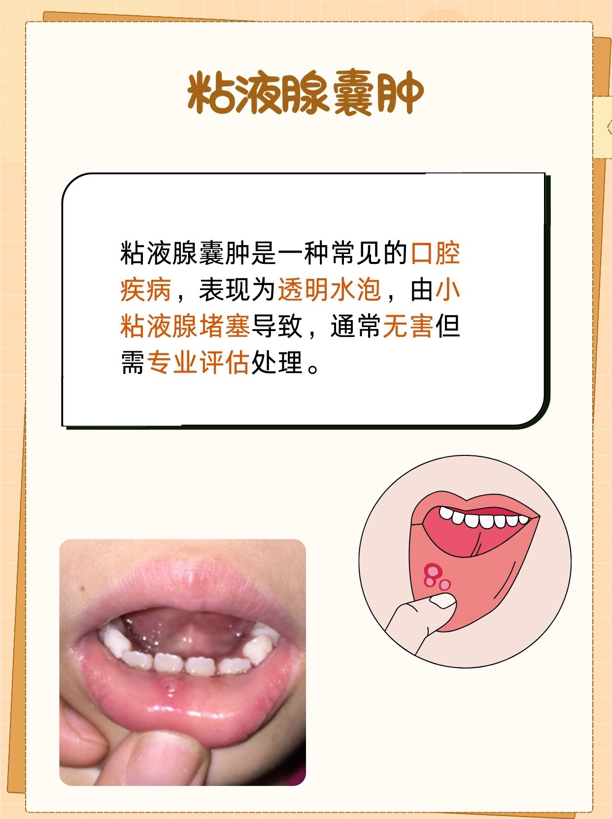 透明隔囊肿是什么意思?