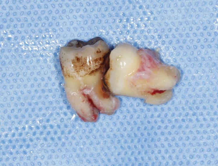 智齿发炎可以拔吗